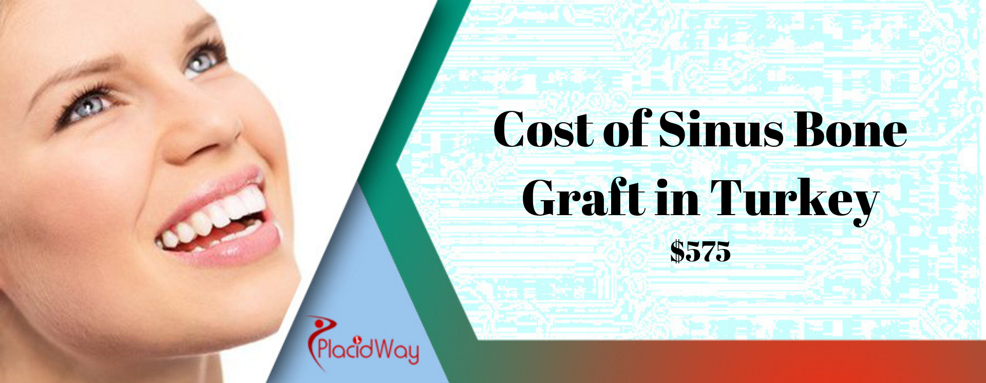 Cost of Sinus Bone Graft